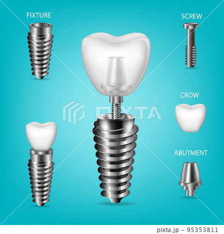 Vector realistic, 3D set of dental implants. Structural elements of a dental implant, isolated. 95353811