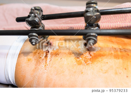 hole in skin from external fixation device on hip hole in skin from external fixation device on hip 95379233