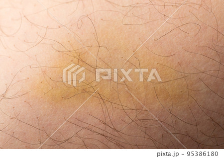 Wound on human skin 95386180