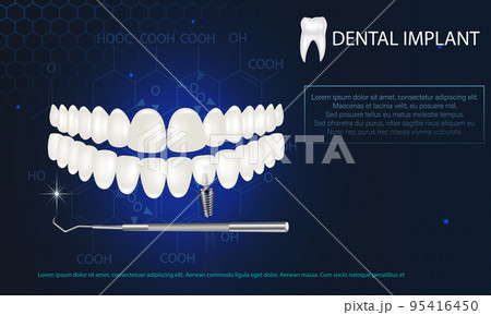 Realistic white dental implant on a blue background. Vector 3d model of a tooth with a thread. 95416450