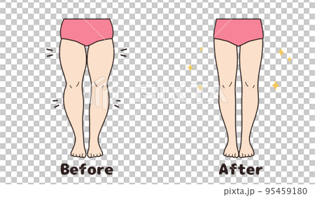 Leg before and after set Leg before and after set 95459180