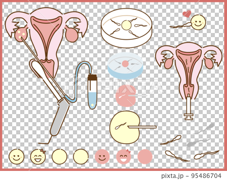 Illustration of fertility treatment, microscopic insemination, in vitro fertilization, artificial insemination 95486704