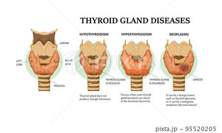 Thyroid gland diseases - hyperthyroidism, hypothyroidism and neoplasms Thyroid gland diseases - hyperthyroidism, hypothyroidism and neoplasms 95520205