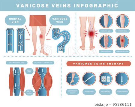 Varicose infographic. Venous disease medical health problems with human blood venous recent vector template set 95536111