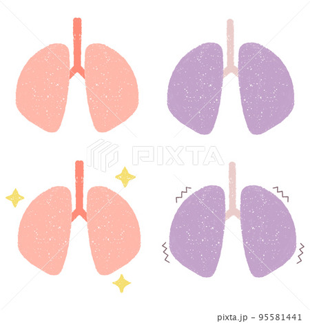 健康な肺と不健康な肺のセットイラスト 95581441