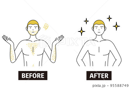 医療脱毛のイメージ、体毛が濃くて悩んでいる男性が脱毛して自信満々になるビフォーアフター 95588749