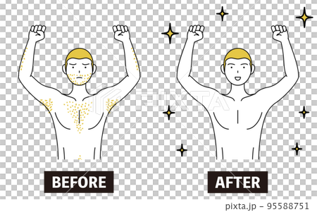 Image of medical hair removal, before and after a man who is worried about having thick body hair loses hair and becomes smooth 95588751