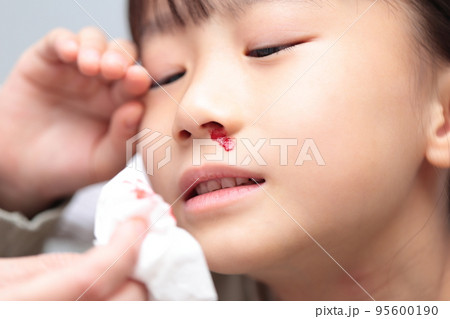 鼻血が出る小学生の女の子 (血のりでイメージ) 鼻血が出る小学生の女の子 (血のりでイメージ) 95600190