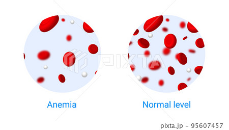 Anemia problem circulatory iron body diagram background. Anaemia biology blood isolated medical 95607457