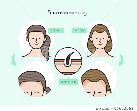 infographic of hair loss treatment, prevention and transplantation 95622663