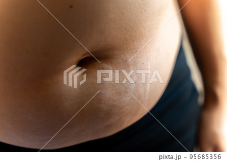 ダイエット 女性 お腹 ウエスト 妊娠線 ダイエット 女性 お腹 ウエスト 妊娠線 95685356