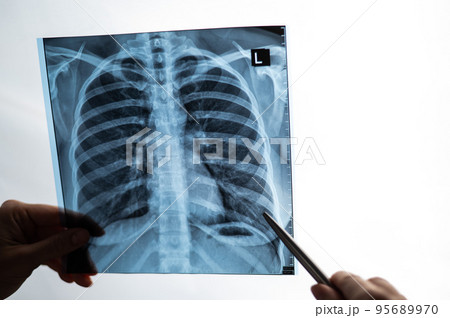 Doctor showing x-ray of patient's lungs.  95689970