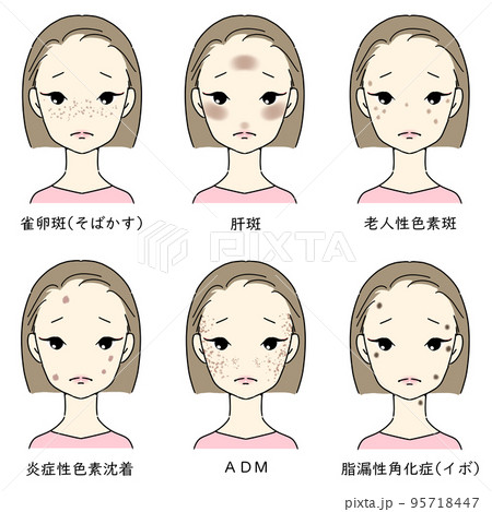 シミ・そばかすに悩む女性セット シミの種類 文字あり のイラスト素材