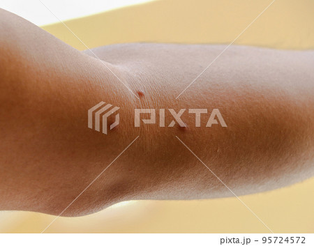 Allergy concept. Young man with pimples 95724572