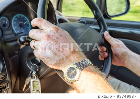 The hands of a man with vitiligo in close-up on the steering wheel control the car. Pigmentation disorder. Lifestyle. The hands of a man with vitiligo in close-up on the steering wheel control the car. Pigmentation disorder. Lifestyle. 95749937