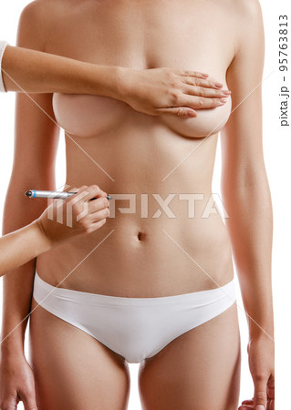 Surgical Lines. Woman Body In White Underwear With Marks On Skin Stock  Photo by ©puhhha 150230496