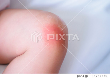 baby skin rash and allergy with red spot cause by mosquito bite at knee baby skin rash and allergy with red spot cause by mosquito bite at knee 95767730