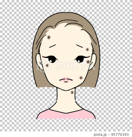 シミ・そばかすに悩む女性　(脂漏性角化症・イボ) 95770393