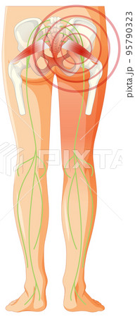 Lower back suffering from ankylosing spondylitis 95790323