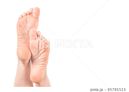 Female legs, feet with dry skin on heels and soles needs care in spa beauty salon. rough skin on female feet isolated on white background 95795523