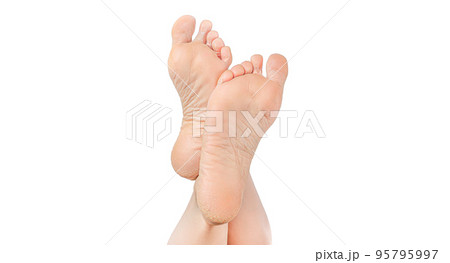rough skin on soles of feet. dry heels, dry chapped skin on feet requiring care isolated on white background, dry skin on heels and soles needs care. copy space 95795997