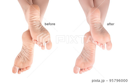Feet with dry skin before and after treatment. dry chapped skin on feet requiring care isolated on white background, dry skin on heels and soles needs care Feet with dry skin before and after treatment. dry chapped skin on feet requiring care isolated on white background, dry skin on heels and soles needs care 95796000