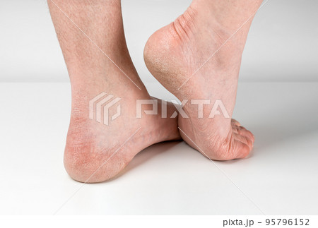 Dry and cracked soles of feet on gray background, man feet with dry heels, cracked skin. Close up of Cracks on Heels with bad skin covered. Healthcare and medical concept. 95796152