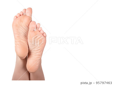 Cracked heel on woman foot. Female feet turned up. Dry heels and soles woman on white background closeup. dry skin on heels and soles needs care 95797463