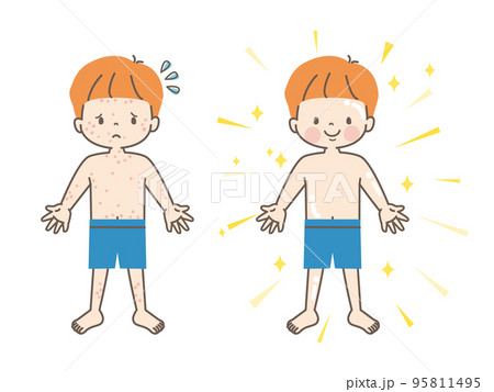 肌荒れに悩む男の子のビフォーアフター_ベクターイラスト素材 95811495