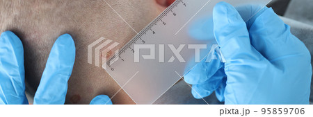 Medical worker measure with ruler mole on patient neck, man checkup birthmark in hospital Medical worker measure with ruler mole on patient neck, man checkup birthmark in hospital 95859706