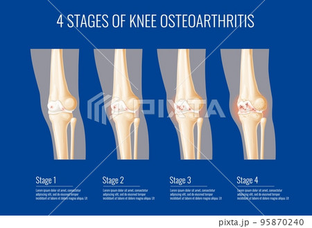 Knee joint osteoarthritis stages, medical infographics on bone cartilage arthritis, vector legs health. Knee joint osteoarthritis disease symptoms, information on knee cartilage inflammation 95870240