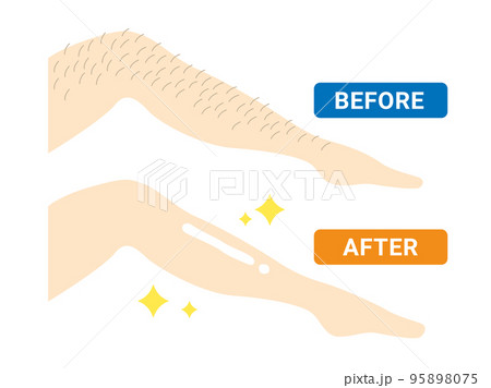 足を脱毛した人の、ビフォーアフターのイラスト 足を脱毛した人の、ビフォーアフターのイラスト 95898075