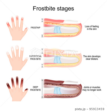 Frostbite stages of fingers 95913459