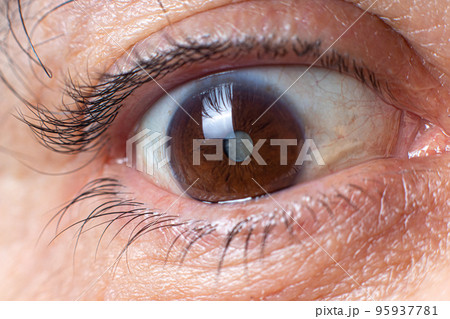 Macro photos of the human eye - cataract clouding of the lens, deterioration of vision. Treatment, surgery and ophthalmology Macro photos of the human eye - cataract clouding of the lens, deterioration of vision. Treatment, surgery and ophthalmology 95937781