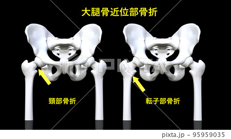 大腿骨近位部骨折（骨盤あり） 95959035