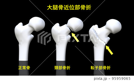 大腿骨近位部骨折 95959065