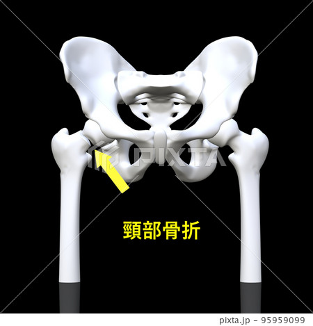 大腿骨頸部骨折 95959099