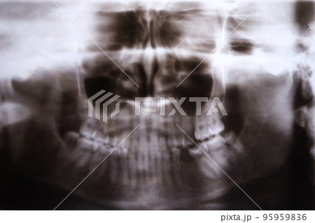 X-ray of a patient with a fracture of the upper jaw X-ray of a patient with a fracture of the upper jaw 95959836