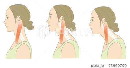 正常な頸椎とストレートネックの女性 95960790