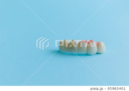 Artificial teeth on a blue background, dental crowns. Concept of dental implantation and restoration 95963401