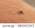 close-up deer tick trying to bite through human skin. Danger Infection through the bite of a dangerous insect that causes Borrelia disease. 96045263