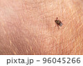 Crawling deer tick on the background of human hairy skin. Infection through the bite of a dangerous insect with a disease. the concept of infection from insects 96045266