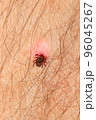 Crawling deer tick on the background of human hairy skin. Infection with dangerous insects with disease. the concept of infection from insects 96045267