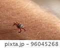 Crawling deer tick on the background of human hairy skin. Dangerous insect infects with disease 96045268
