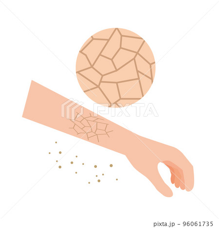 乾燥でひび割れする皮膚 96061735