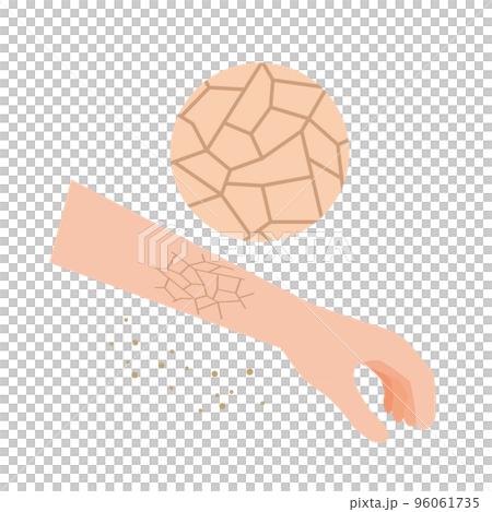 乾燥でひび割れする皮膚 96061735