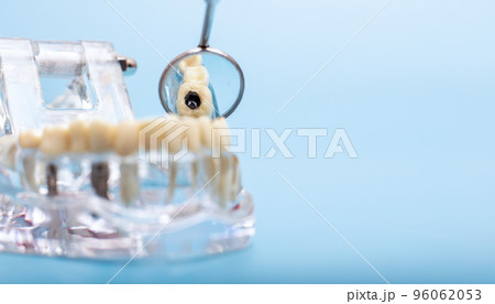 Dental jaw model over blue background. Dentist dental prosthetic teeth, gums, roots close-up. 96062053