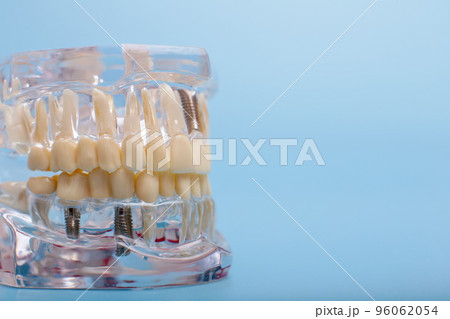Dental jaw model over blue background. Dentist dental prosthetic teeth, gums, roots close-up. 96062054