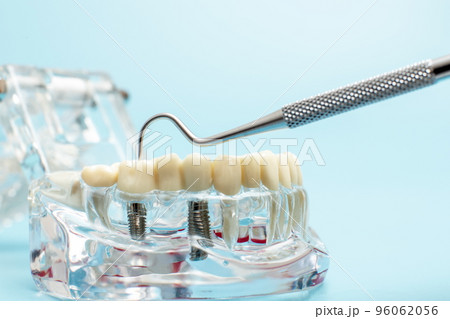 Dental jaw model over blue background. Dentist dental prosthetic teeth, gums, roots close-up. Dental jaw model over blue background. Dentist dental prosthetic teeth, gums, roots close-up. 96062056