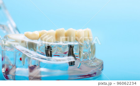 Dentist dental prosthetic teeth, gums, roots close-up. Studying dental diseases concept 96062234